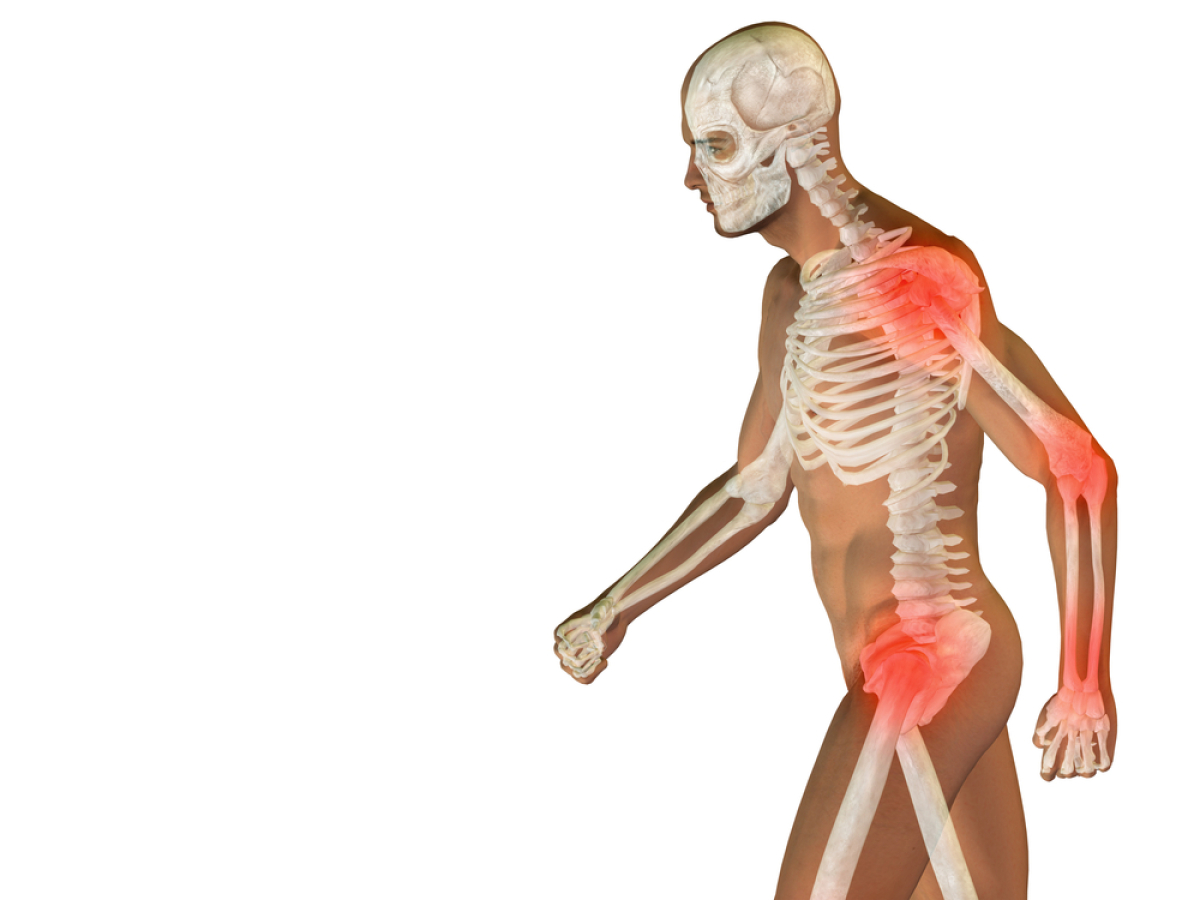 osteoporóza. 