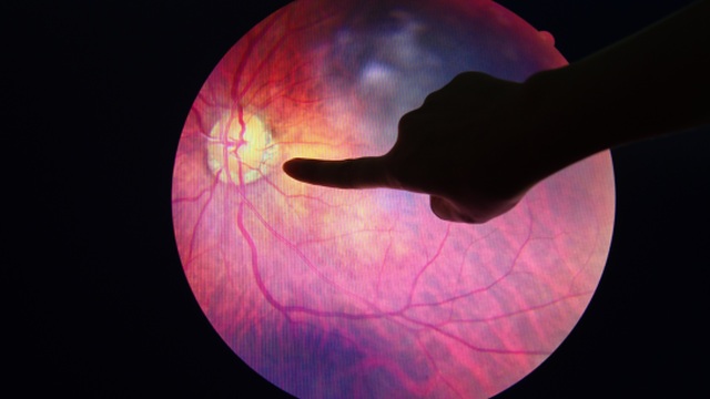 Diabetická retinopatia môže viesť k úplnej strate zraku.