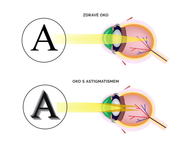 astigmatismus, zrak