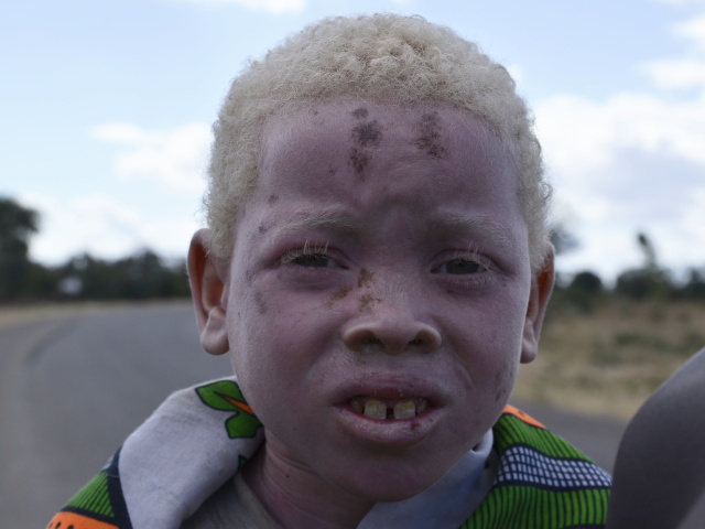 albín, albinizmus, Afrika