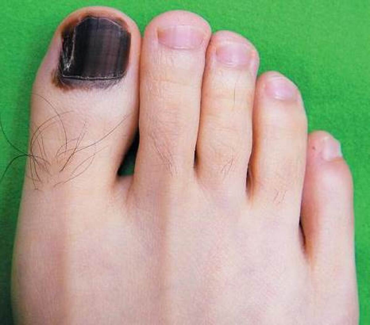 podnechtový melanóm, čierny necht, necht
