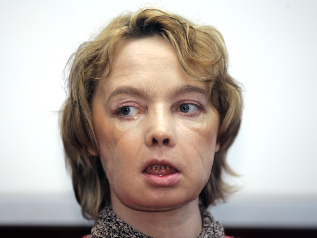 Dňa 28. mája 2005 sa Isabelle Dinoire prebudila v kaluži krvi. 27. novembra toho istého roka jej transplantovali časť tváre.